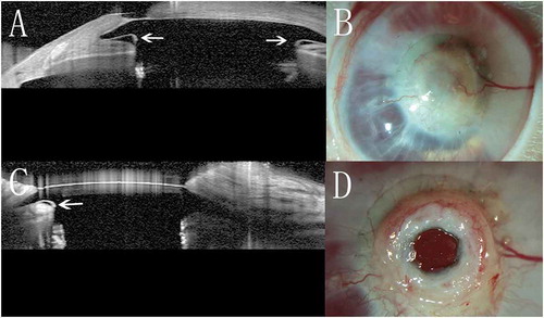 Figure 3. Implanted chondro-Kpro in rabbit 1. A. AS-OCT horizontal scan revealed a gap (arrow) on both sides between the posterior surface of the anterior plate and cartilage. B. The membrane over the anterior plate becomes translucent 8 months post-operation. C. AS-OCT horizontal scan showed that the gap between the anterior plate and cartilage was replaced by regenerative tissue; the gap (arrow) was only present on the left side, and the height decreased. D. After dissection of the granular tissue over the anterior plate 22 months post-implantation, no obvious retroprosthetic membrane was observed.