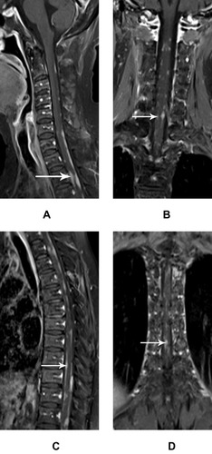 Figure 4 Multiple intraspinal metastatic lesions accompanied by patchy thickened meninges.Notes: Intraspinal metastases in a 64–year–old female with breast cancer. Gadolinium contrast MR images (A–D) show obviously enhanced nodules closely adherent to the slightly thickened meninges; the lesions have sharp margins and clear distinction between them (white arrow).Abbreviations: T2WI, T2-weighted imaging; MR, magnetic resonance.