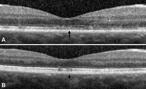 FIGURE 2  Spectral Domain Optical Coherence Tomography ((SD-OCT) Spectralis; Heidelberg Engineering, Germany), right eye. Baseline OCT shows disruption of the inner segment-outer segment junction (arrow) (A). OCT five months following treatment shows restoration of the inner segment-outer segment junction (arrowhead) (B).