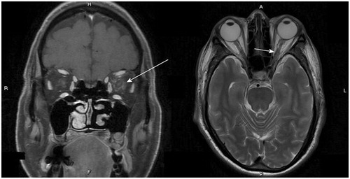 Figure 1. Left panel: On the post-enhanced T1W images of the brain MRI, heterogeneous enhancement of the orbital fat was noted bilaterally, which is more severe over the left side (arrow). Infiltration of the optic nerve by neoplasm is likely. Right panel: On the T2-weighted images of the brain MRI, there was swollen retrobulbar intra-orbital segment of the left optic nerve (arrow).
