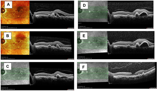 Figure 7 OCT images of combination therapy for persistent disease activity in PCV.