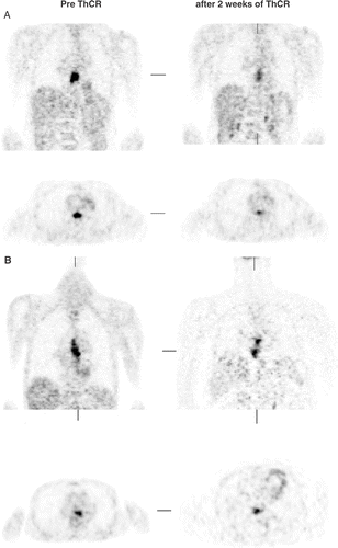 Figure 2. Examples of fluorodeoxyglucose (FDG) positron emission tomography studies (coronal and axial slices) before and 2 weeks after thermochemoradiation therapy, in (a) histopathologically responding and (b) non-responding tumours.