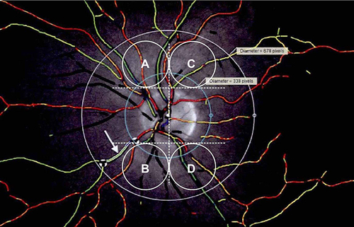 Figure 4 Retinal microvascular diameter measurement. The measurement area was 1–1.5PD, as outlined by the two circles with a distance of 0.5PD. Red color indicates artery and green color indicates vein. (A) superior temporal, (B) inferior temporal, (C) superior nasal, (D) under nasal.