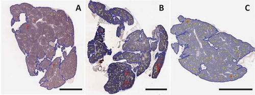 Figure 2. Image analysis of Congo Red staining for islet amyloid in three patients with type 1 diabetes. Sections were stained and analyzed with Congo Red as described in Methods. Whole slide scans were manually annotated for total pancreas area (blue) and islets (yellow). Amyloid area within islets (red) was identified using the tissue classifier within HALO image analysis software. A pancreas body section from case 6371 (A) and pancreas tail from 6362 (C) showed scattered and infrequent islet amyloidosis. A pancreas tail section from case 6414 (B) showed clustering of islet amyloidosis in two lobules (shown in higher magnification in Figure 3). Scale bars: 2 mm. Whole slide images are available through the nPOD Online Pathology Database (https://www.jdrfnpod.org/for-investigators/online-pathology-information/).
