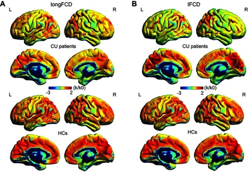 Figure 2 One sample t-test differences of CU patients and HCs in binarized longFCD and IFCD. The red areas denote higher values and the blue areas denote lower values. (A) Significant longFCD differences were observed in the right hippocampus/inferior temporal gyrus, left inferior temporal gyrus. The means of altered longFCD between the CU patients and HCs (voxel level P<0.01 and cluster level P<0.05, Gaussian random field (GRF) theory corrected). (B) Significant IFCD differences were observed in the left inferior temporal gyrus/middle temporal gyrus, left limbic lobe/medial frontal gyrus, left precuneus/limbic lobe, right insula/superior temporal gyrus, left superior temporal gyrus/inferior frontal gyrus/insula, right superior temporal gyrus/postcentral gyrus, left precentral gyrus. The means of altered IFCD between the patients with CU and HCs (voxel level P<0.01 and cluster level P<0.05, Gaussian random field (GRF) theory corrected).