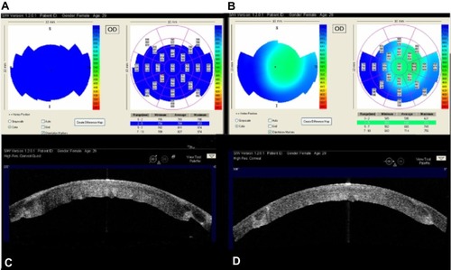 Figure 10 High resolution AS-OCT images and pachymetry maps of the right eye of a 28-year-old female patient 3 years after penetrating keratoplasty. The condition was prediagnosed as acute graft rejection.