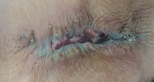 Figure 7 Defective wound healing.