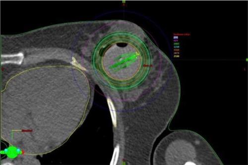 Figure 1 A representative axial CT image of a patient treated on the PB-IORT protocol.