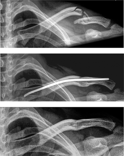 Figure 4. Lateral nailing (ESIN) of a displaced fracture in a 32-year-old man (upper and middle panels) and after implant removal 5 months later (lower panel).