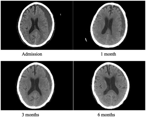 Figure 4. CT brain scan of a 75-year-old gentleman presented with unsteady gait.