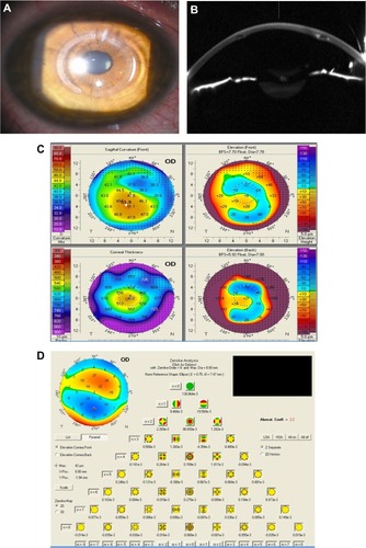 Figure 2 Imaging of cornea after ring implantation.