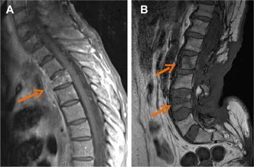 Figure 5 Contrast-enhanced magnetic resonance images showing contiguous spread of pulmonary actinomycosis to the spine (case 2), with thoracic spondylitis of the T3 vertebral body, associated with anterior paravertebral abscess (arrow) (A). Magnetic resonance image showing back soft tissue infiltration, with posterior epiduritis and infection of L2 and L4 vertebral bodies (arrows) in a paraplegic patient with plurimicrobial bone and joint infection following chronic back scar (case 6) (B).