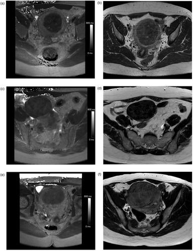 Figure 2. Example pretreatment axial T2 relaxation time maps and the corresponding screening MRI axial T2-weighted images illustrating the Funaki classification: (a) T2 I: T2 value of 48 ms, (b) Funaki II, (c) T2 II: T2 value of 66 ms, (d) Funaki I, (e) T2 III: T2 value of 89 ms, and (f) Funaki II.