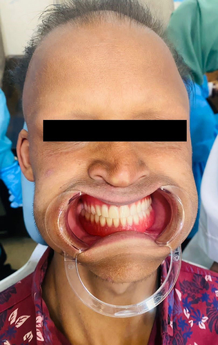 Figure 7 Post treatment full mouth view.