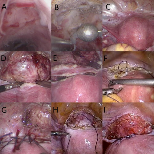 Figure 1. (A) Hysteroscopy of the cesarean scar defect (CSD). (B) Hysteroscopy after electrical resection of the scar (canal opening) and electrocoagulation of the diverticular endometrium. (C) Laparoscopy of the CSD. (D) Laparoscopic visualization of the diverticulum with guidance from the light source of the hysteroscope after opening and deflecting the vesicouterine pouch. (E) The muscle flap filling suture method: a monopolar electrical probe was used to make a transverse incision in the myometrium 1 cm above the diverticulum to a depth of approximately 0.5 cm. (F) The muscle flap filling suture method. (G) After muscle flap filling suture. (H) The folding suture method. (I) After folding suture.