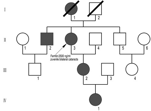 Figure 1. A four-generation family pedigree with HHCS. The proband is shown arrowed. Circles denote female family members and squares male family members. Black symbols indicate individuals with HHCS. Open symbols indicate non-affected individuals.