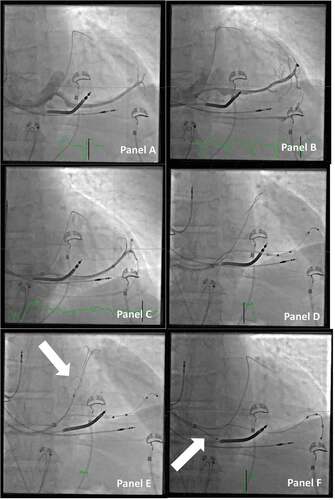 Figure 6. Choosing the right and stable position for the lead. Panel A: Direct venography through the vein selector shows a long, straight target vessel, without natural curvatures for fitting an s-formed quadripolar lead in a stable position. Panel B: When the venography is repeated with the vein selector in a deeper position, it then reveals several collaterals that may be a suitable target for the lead. Panel C: More wires are added to access the different veins, and with more wires comes more options for the final position. Panel D: A quadripolar lead is delivered OTW, but the tip is not inserted deep enough to be in a stable position. The guidewire used for OTW is through the collaterals back into the main CS. Panel E: The guidewire through the collateral back into the main CS is caught with a snare (arrow). Panel F: By applying a firm pull on the snare, the guidewire now serves as a better rail for pushing the lead forward to a wedged and stable position in the target branch. Note that the outer coronary sinus guide is retracted back to the right atrium to avoid bending of the wire (arrow).