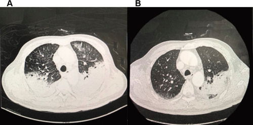 Figure 1 Chest computed tomography (CT) scans of a 66-year-old man with C. psittaci pneumonia. Lungs were exuding consolidation foci, bilateral pectoral effusions, consolidation on the 8th day of hospitalization (A). After treatment, on the 18th day of hospitalization (B), the image of four patients improved, and the patients’ lung exudation, consolidation, and bilateral pleural effusion were less than before.