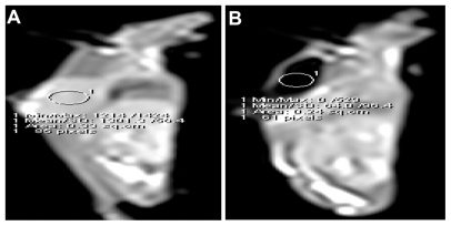 Figure 7 Sagittal T1WI MR images before and after core shell treatment. (A and B) The images revealed loss of signal intensities and complete disappearance of the tumor at the end of the treatment after subjecting to green, NIR, and AMF.Abbreviations: T1WI, T1 weighted images; MR, magnetic resonance; NIR, near-infrared; AMF, alternative magnetic field.