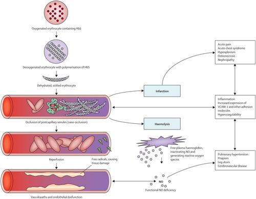 Figure 1 Pathophysiology of sickle cell disease.