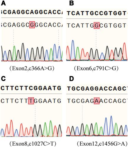 Figure 1 Genetic analysis of the SLC12A3 gene. (A) c.366A > G in Exon 2. (B) c.791C > G in Exon 6. (C) c.1027C > T in Exon 8 and (D) c.1456 G > A in Exon 12. The mutant nucleotides are marked in the red frames.