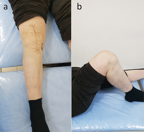 Figure 5 Photograph of the knee joint 48 months after spacer implantation knee joint is determined. (a) in the frontal plane; (b) in the sagittal plane.