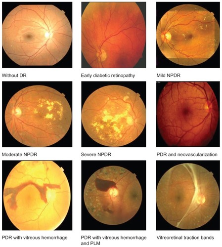 Figure 3 Fundus images of normal (background retinopathy), mild NPDR, moderate NPDR, severe NPDR, PDR, PDR with new vascularization, and PDR with PLM and with vitreous hemorrhage.