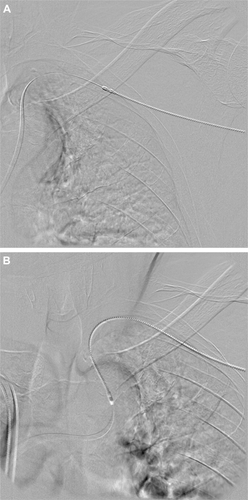 Figure 2 (A) and (B) 6F Rotarex® catheter in position.