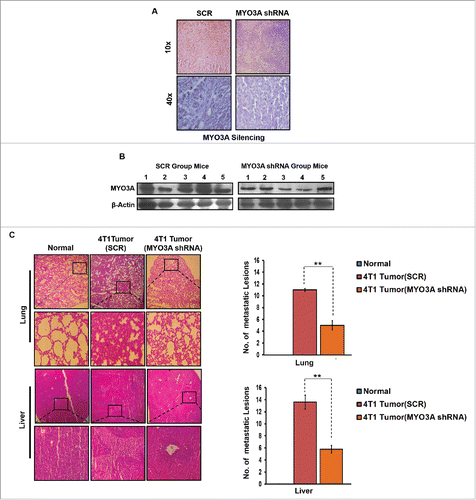 Figure 10. In vivo blockade of MYO3A expression was followed by reduced cellular burden in lungs and diminished presence of metastatic foci in liver of syngenic 4T1/BALB/c mouse model of breast cancer. (A and B) Confirmation of MYO3A silencing by IHC and protein gel blot analysis in mice tumor tissue. (C) On day 26th post grafting, compared to controls (Scr), the intratumoral administration of MYO3A shRNA resulted in regressed tumor volume and reduced cellular burden in lungs and perivascular regions of liver from 4T1/BALB/c mouse models. Lung and liver sections obtained from healthy uninoculated mice served as mock control. Bars represent no. of metastatic lesions ±SE (*p < 0.05.). All the experiments were done in triplicates. Abbreviations—4T1 tumor (SCR): 4T1-induced tumor treated with scrambled shRNA; 4T1 tumor (MYO3A): 4T1-induced tumor treated with MYO3A shRNA.