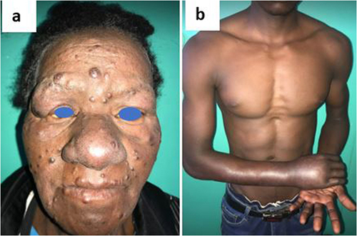 Figure 1 (a) Lepromatous leprosy with diffused papulonodular skin-colored lesions on the face; (b) neuritis.