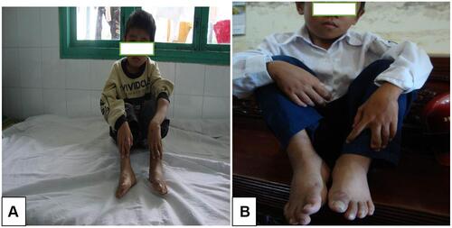 Figure 4 Patient with swelling of both hands and feet before treatment (A) and no swelling in hands and feet, no pleural effusion after successful treatment (B).