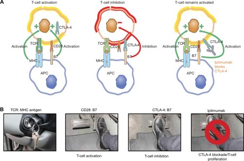 Figure 1 (A and B) Role of CTLA-4 in T-cell responses and the impact of CTLA-4 blockade with ipilimumab. Ipilimumab mechanism of action (A) and “brake and pedal” analogy (B) as used to explain the mechanism to patients and caregivers.Abbreviations: CTLA, cytotoxic T-lymphocyte antigen; APC, antigen-presenting cell; MHC, major histocompatibility complex; TCR, T-cell receptor.