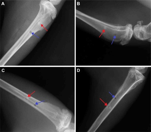 Figure 3 The results of X-ray.Notes: Results of X-ray at 2 weeks (A), 4 weeks (B), 12 weeks (C), and 24 weeks (D) postoperative. The red arrow represents experimental group. The blue arrow represents control group.