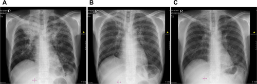 Figure S2 Chest X-rays of Patient 2 depicting (A) infiltrates in both lungs and cavities in the left lung; (B) right upper lobe fibrosis; and (C) infiltrates in the right lung and infiltrates and new lesions in the left lung.