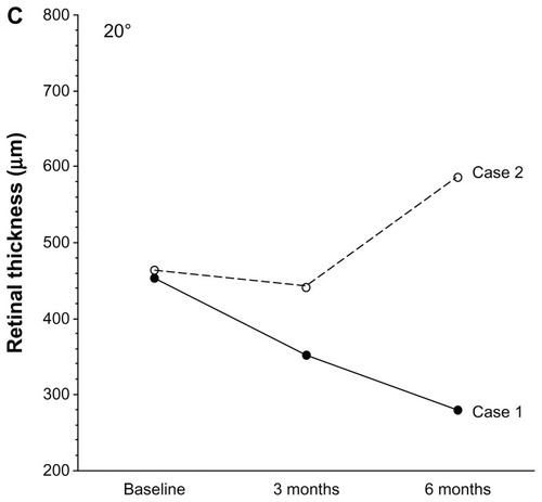 Figure 2 Changes in mean macular thickness (A–C) after intravitreal injection of triamcinolone acetonide in two patients with branch retinal vein occlusion and macular edema. (A) Case 1: mean macular thickness within the central 4 degree field is reduced after 3 and 6 months. Case 2: mean macular thickness within the central 4 degree field is reduced after 3 months, but increased at 6 months compared with at 3 months. (B) Case 1: mean macular thickness within the 10 degree field is reduced after 3 and 6 months. Case 2: mean macular thickness within the 10 degree field is reduced after 3 months, but increased at 6 months compared with at 3 months. (C) Case 1: mean macular thickness within the 20 degree field is reduced after 3 and 6 months. Case 2: mean macular thickness within the 20 degree field is reduced after 3 months, but increased at 6 months compared with at 3 months.