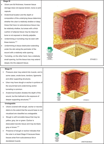 Figure 1 Pressure ulcer staging. Images are reused with permission from the National Pressure Advisory Panel. Copyright © 2009. http://ww.npuap.org/.