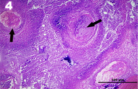 Figure 4. Thrombus formation (arrows) and fibrosis in the carotid rete.