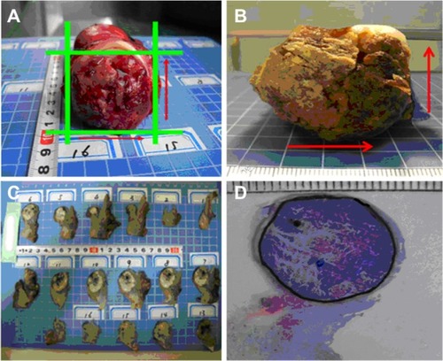 Figure 1 (A–D) Pathology procedure. The specimens are collected from surgery (A) and fixed in 10% formalin (B). The fixed specimens are sliced in 4 mm-thick consecutive transverse slices (C). Each slice is embedded in paraffin, sectioned, and processed for hematoxylin and eosin staining (D).