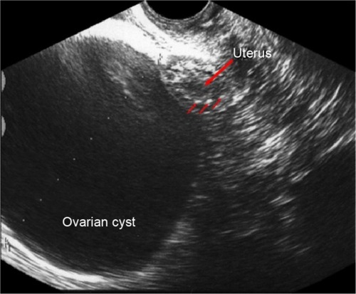 Figure 1 Ultrasonographic view of the cyst adherent to the uterine fundus.