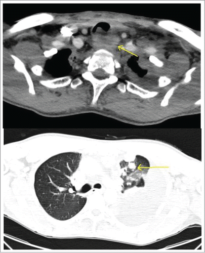Figure 2. Above – CT scan of the chest demonstrating metastatic disease compressing the esophagus. Below - worsening pulmonary nodules with a massive left sided pleural effusion.