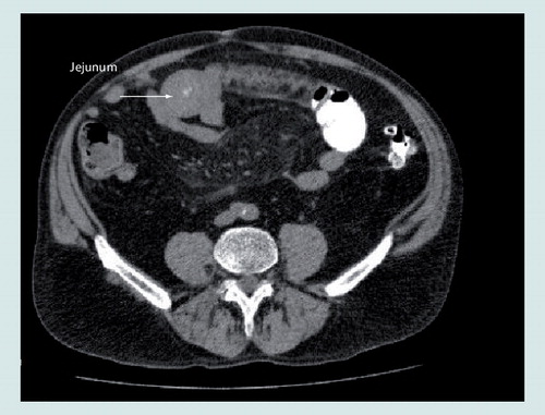 Figure 1. Computed tomography showing intramural hematoma with circumferential wall thickening of the jejunum.