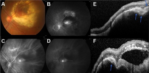 Figure 3 The right eye of a 73-year-old male (case 6) with polypoidal choroidal vasculopathy, who was diagnosed with choroidal melanoma.