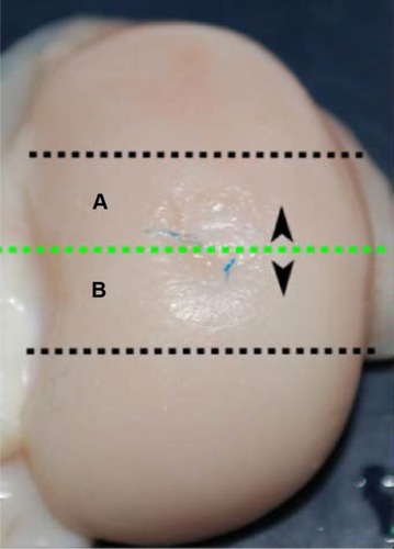 Figure 3 Preparation of the condyles.