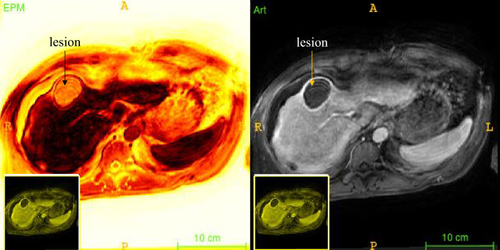 Figure 2 Representative ROI used for CNR analysis of the image intensity on EPM (left) and on arterial phase MRI (right) with lesion indicated.