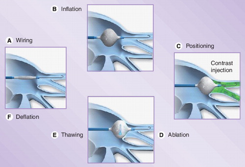 Figure 1. Sequence of steps in the cryoablation procedure of atrial fibrillation.Figure provided courtesy of Medtronic (MN, USA).