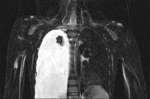 Figure 5. Patient no 1, boy at age 9 year with asymptomatic right chylothorax 4 years after initial diagnosis of GSD.