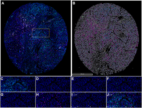 Figure 9 Seven-colour multiplex analysis of human malignant liver tissues. (A) Representative image showing the same TMA core after multispectral imaging. (B) Cell phenotype map defined by the seven markers in the multiplex staining. (C-I) Each of the individual markers in the composite image after spectral unmixing ((C) SLC10A3, (D) CD4, (E) CD20, (F) CD68, (G) DAPI, (H) PD-1, (I) PD-L1). (J) The merged picture of seven markers after multispectral imaging. (A) Is the entire view of one case of malignant liver tissue, and the yellow box is the random area for magnified view, which is corresponding to (C–J) with different markers.