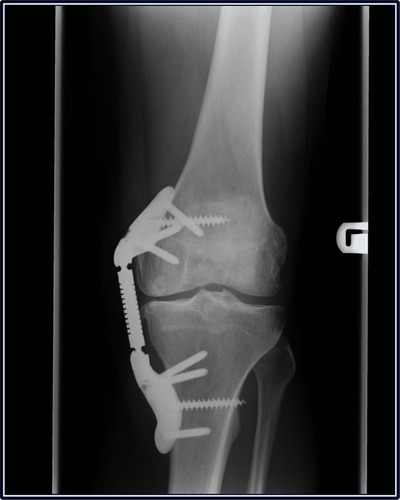 Figure 5 Weight-bearing radiograph of left knee demonstrating successful KineSpring® System following two-stage revision procedure.