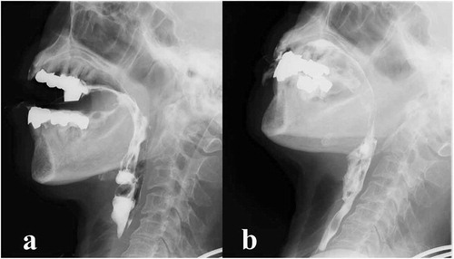 Figure 2. Videofluoroscopic examination of swallowing (VF) of the patient.