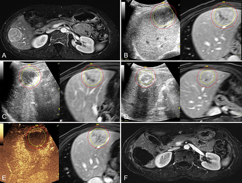 Figure 2 A 54-year-old woman had a 4.4 cm HCC lesion. (A) Contrast-enhanced MR showed a medium-sized HCC nodule (44 x 30 mm) in segment VI. (B) The DICOM format of contrast-enhanced MR was obtained and imported into the ultrasound FI system, and the target HCC nodules (yellow) and 5mm-AM (red) were outlined on the MR-US FI. (C and D) The target HCC nodules were ablated with a single electrode guided by MR-US FI, especially if the nodules became inconspicuous after ablation. (E) After 16 ablation cycles, MR-CEUS FI showed that the non-perfusion area on the CEUS covered the entire target HCC nodule and its 5mm-AM. (F) One month later, contrast-enhanced MR confirmed complete ablation.